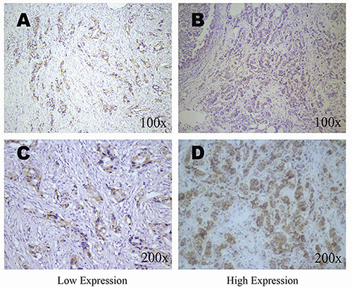 Immunohistochemical staining of HABP1 in breast tissues.