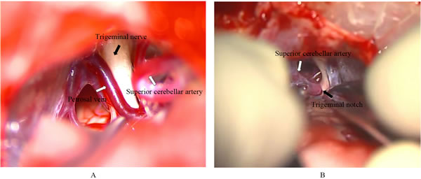 Intraoperative photographs of trigeminal nerve lysis.