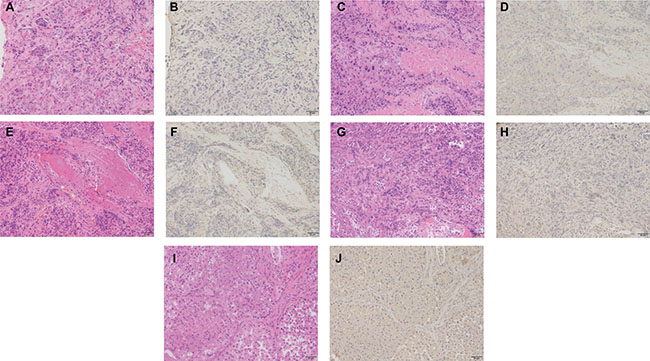 Immunohistochemical staining for CX3CR1 expression in metastatic spinal tumor tissue sections.