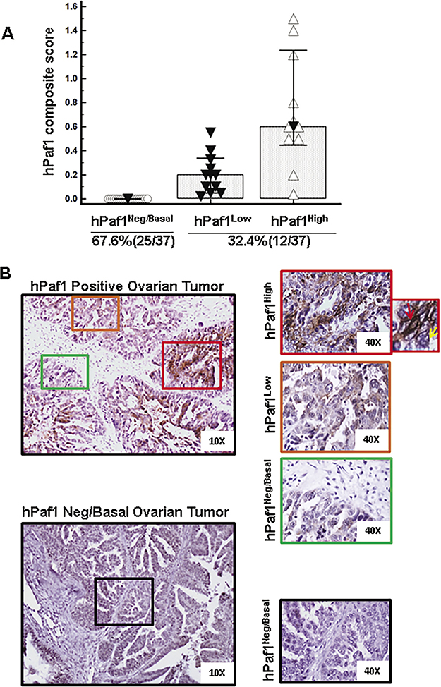 Expression of hPaf1/PD2 in human ovarian cancer tissues.
