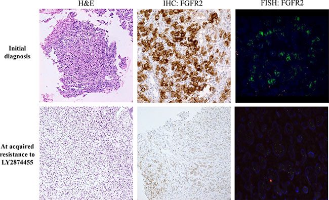 Pathology (hematoxylin &#x0026; eosin staining, H&#x0026;E), IHC, and FISH results in primary tumor tissues at the time of diagnosis (upper row) and at the time of acquired resistance to LY2874455 (lower row).