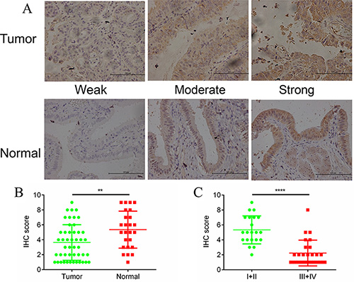 DUSP1 expression in gallbladder tumor/normal tissues and its different expression level in tumors from different tumor stages.