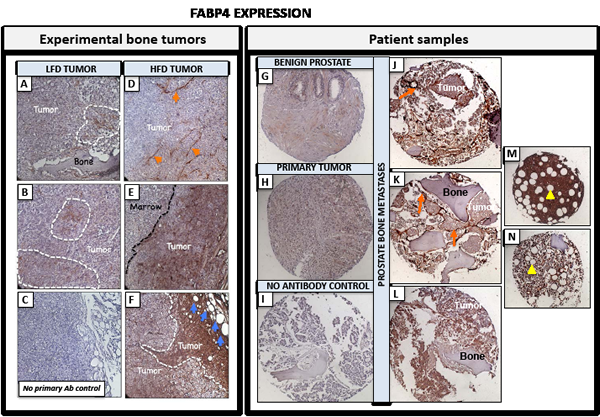 FABP4 is strongly expressed in experimental PC3 bone tumors from HFD mice and in bone metastatic tissues from prostate cancer patients.