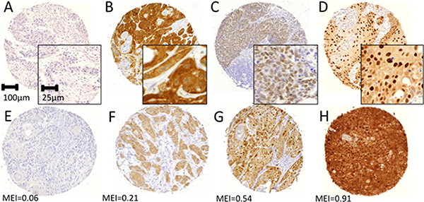 Representative immunohistochemical staining examples for pan-MAGE (M3H67).