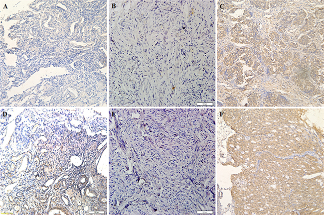 E2F-1 expression is correlated with pathogenesis and aggressiveness of ovarian carcinoma.