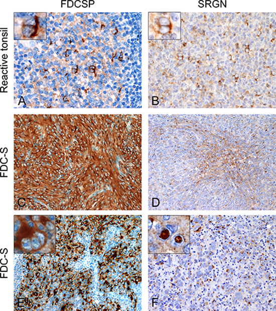 Expression patterns of FDCSP and SRGN on normal and neoplastic FDC.