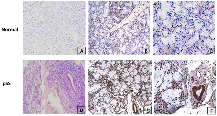 Evaluation of MDM2 protein expression in normal and pSS labial gland tissue by immunohistochemistry.