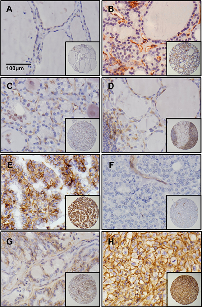 Dysadherin is only expressed in malignant thyroid tissues.
