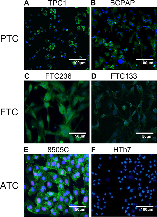 Immunofluoresence of dysadherin in human thyroid cancer cell lines.