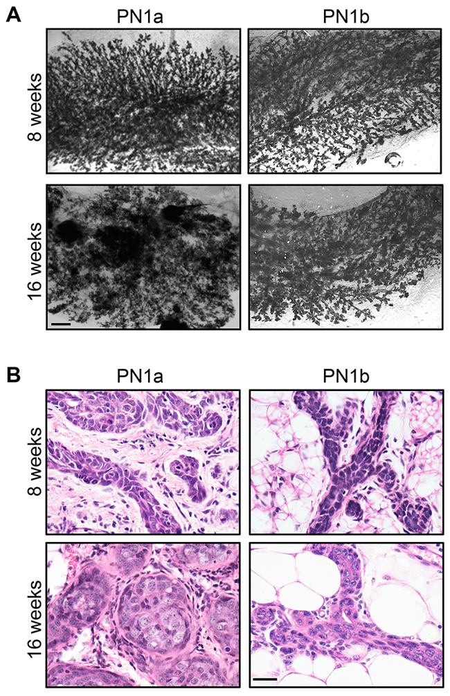 PN1a lesions progress to invasive cancer.