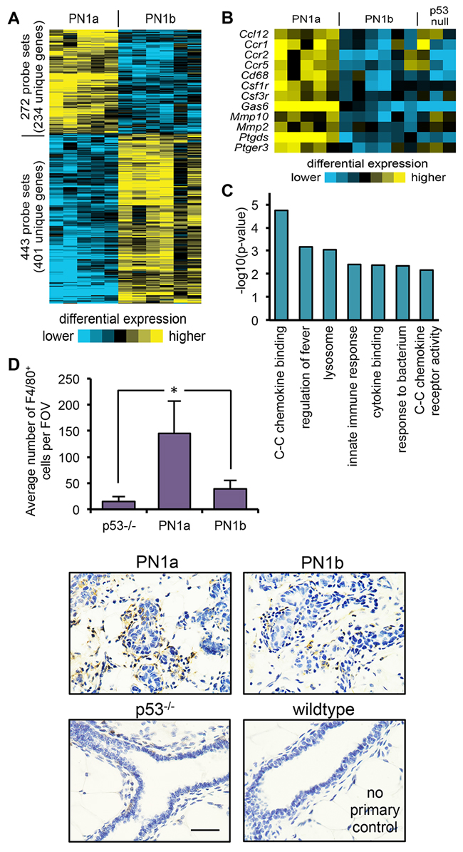 PN1a lesions have increased infiltrating macrophages as compared to PN1b lessions.