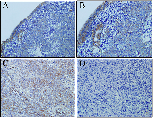 ULBP4 expression in adjacent normal epithelia and carcinoma cells as evaluated by immunohistochemistry analyses.