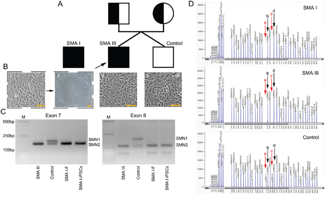 SMN gene mutation screening of cell lines from the three individuals.