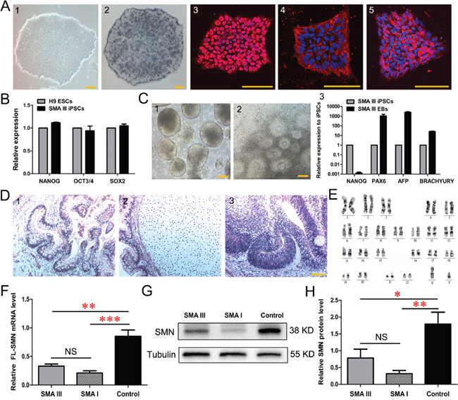 Characterization of urine derived-iPSC colonies (SMA III iPSCs).