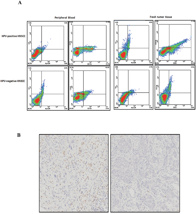 MDSCs expression in peripheral blood and fresh tumor tissue samples of HNSCC.