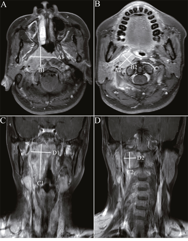 Unidimensional and bidimensional measurements of nasopharyngeal carcinoma in axial and coronal T1-weighted postcontrast MR images.