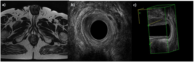 Man 42y, anal cancer.