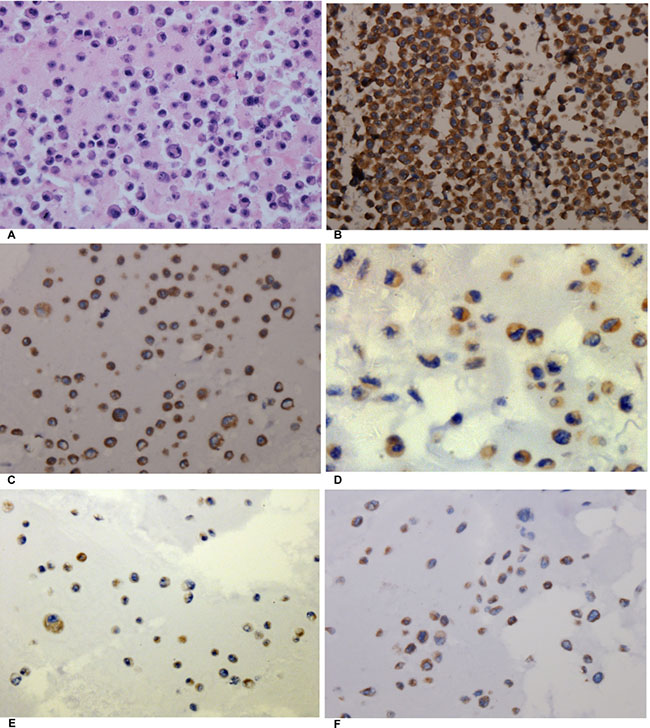 The expression of AEG-1 in different cell blocks of NSCLC cell lines.