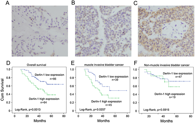 Expression pattern of Derlin-1 protein in bladder cancer tissues.