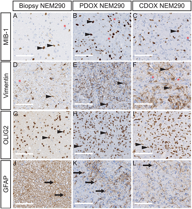 PDOX and CDOX NEM290 models harbor consistent histopathological features of the DIPG tumor of origin.