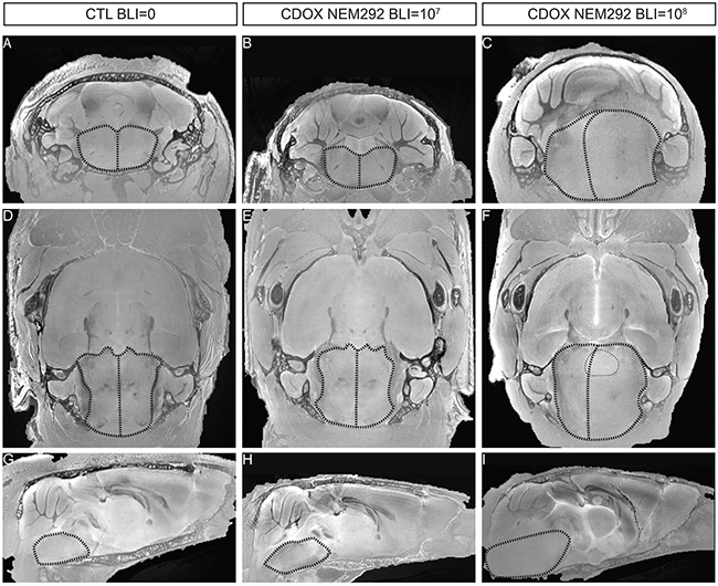 T2-sequence MRI modalities of DIPG are recapitulated in the brainstem of end-stage CDOX models.