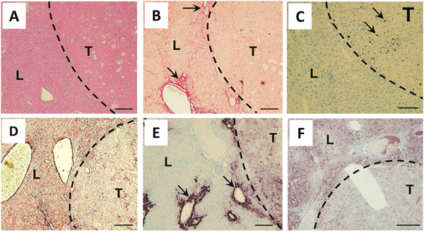 Tumors in Abcb4-/-/HBsAg+/- mice show histological characteristics of HCC.