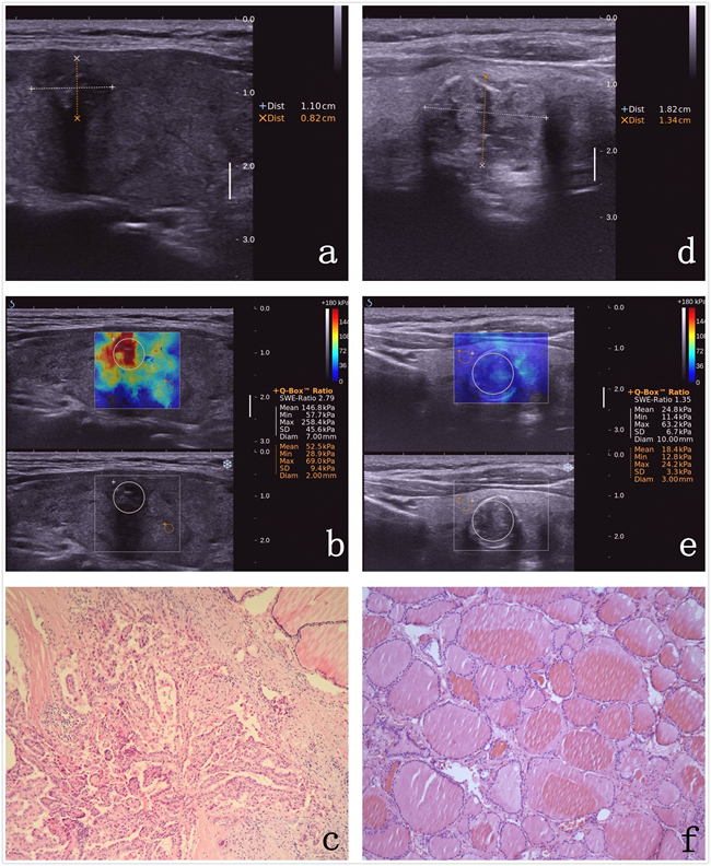 Images in a 64-year-old woman who underwent a routine checkup.