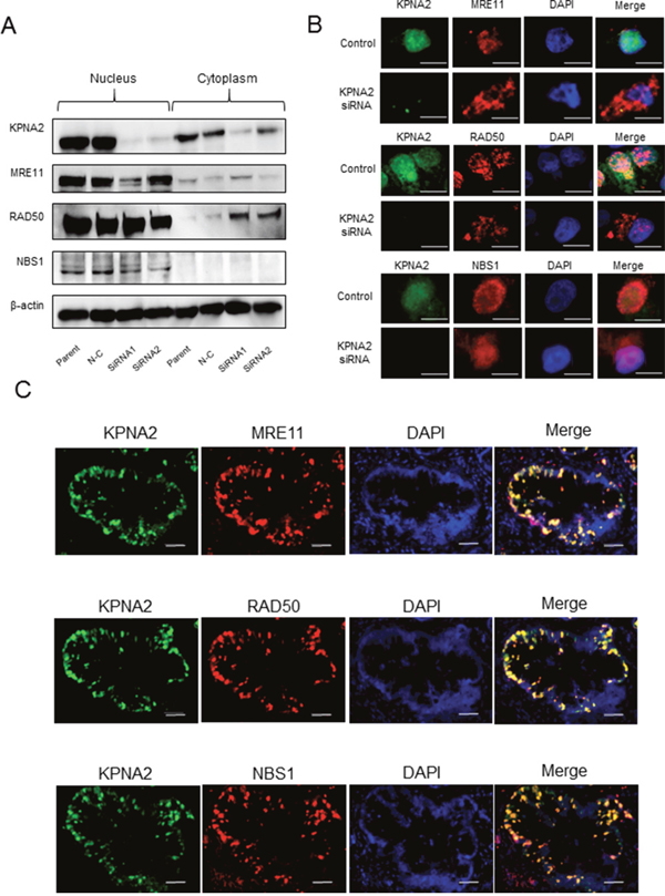 Karyopherin-&#x03B1;2 (KPNA2) and MRE11-RAD50-NBS1 (MRN) complex expression in cholangiocarcinoma cell lines and tissues.
