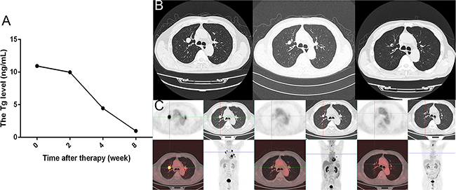 The Tg, CT, and PET/CT results obtained before and after apatinib therapy in a male patient.