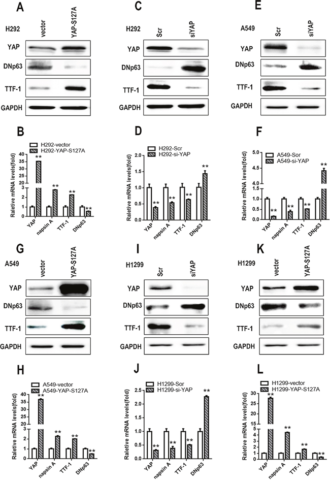 S100A7 and YAP have opposite effects on lung ADC to SCC transdifferentiation in lung cancer cells.