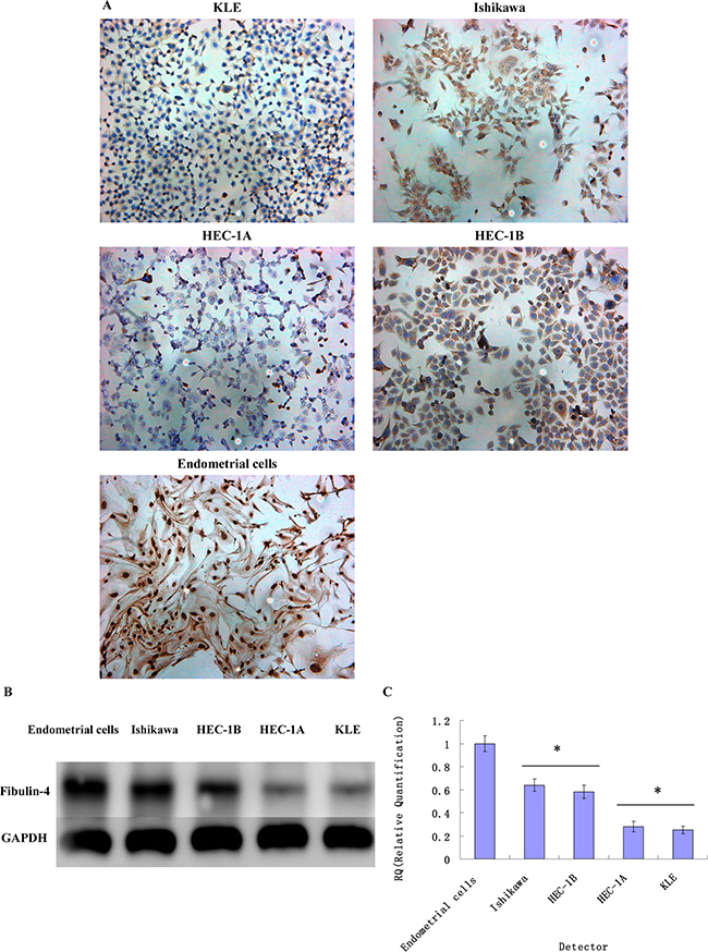 Fibulin-4 expressions in endometrial carcinoma cells and normal endometrial cell.