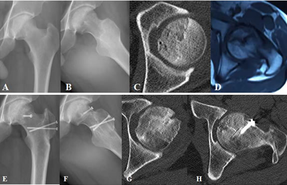 Thirty two-year male patient with alcohol-induced femoral head necrosis of left hip.