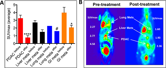 Listeria-32P reduces grow of tumor and metastases (liver and lungs) in KPC mice with advanced pancreatic cancer.