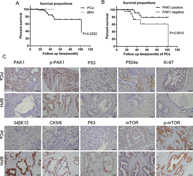 Survival curves, immunohistochemical staining for PAK1, p-PAK1, P53, P504s, Ki-67, 34&#x03B2;E12, CK5/6, P63, mTOR and p-mTOR protein expression of PCa and BPH patients tissues.