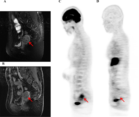 A representative case of uterine leiomyosarcoma (LMS, 41-y-old patient, FIGO stage I).