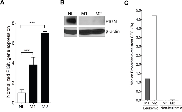 PIGN expression aberration resulted in an increased frequency of GPI-AP deficiency.