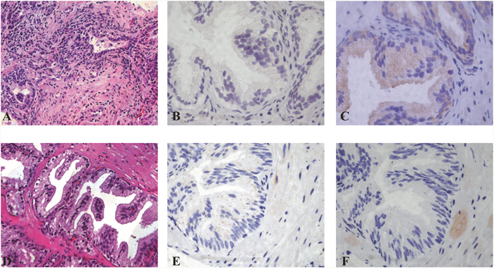 Staining of LC3B and P62 in prostate glands in different inflammatory conditions.