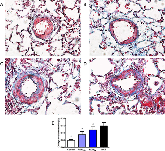 Effects of RDN on MCT-induced pulmonary vascular fibrosis histological section of pulmonary vascular.