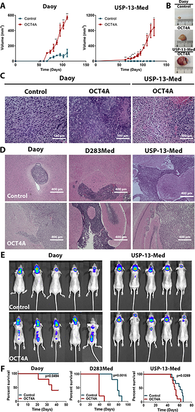 OCT4A overexpression significantly enhances tumorigenicity of medulloblastoma cells.