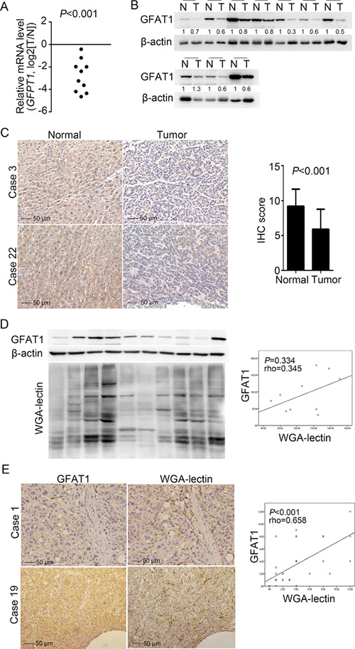 GFAT1 expression is decreased in HCC sample tissues.