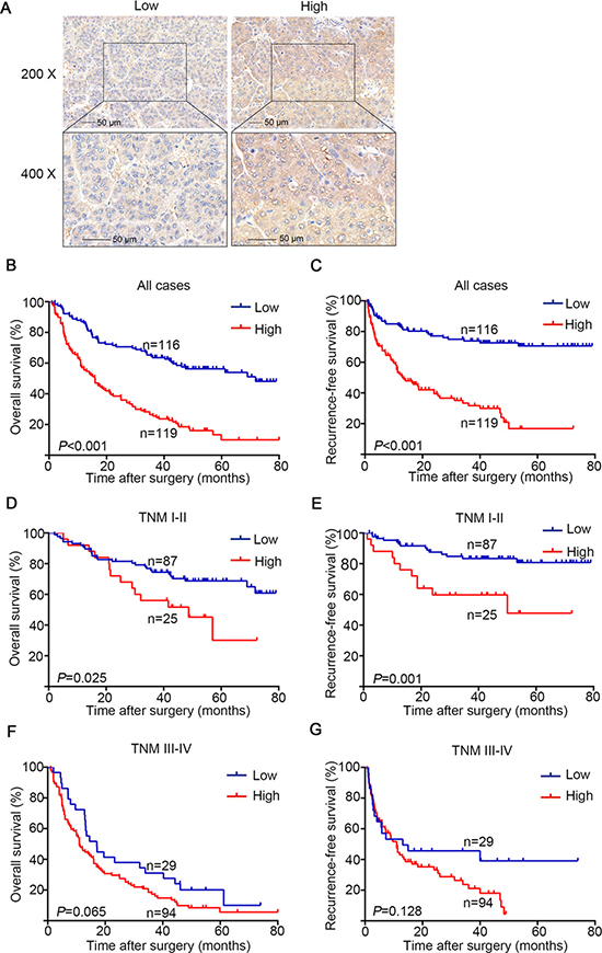 OS and RFS analysis of patients with hepatocellular carcinoma based on GFAT1 expression.