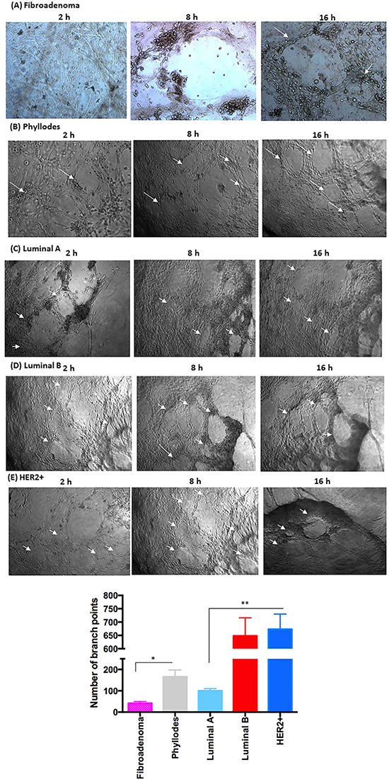 Co-culture of breast tumor cells under PRP supplementation and the formation capillary-structure tubes induced by HUVEC.