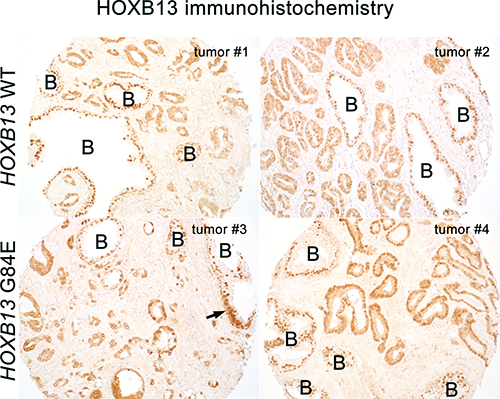 HOXB13 protein is expressed in the nuclei of benign glands (denoted by a B) at similar levels in G84E carriers and non-carriers (G84E WT).