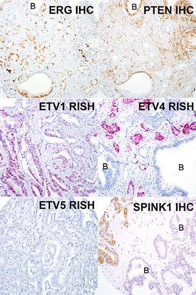 Representative images of ERG, PTEN, and SPINK1 immunohistochemistry (IHC) and ETV1/4/5 RNA in situ hybridization (RISH).
