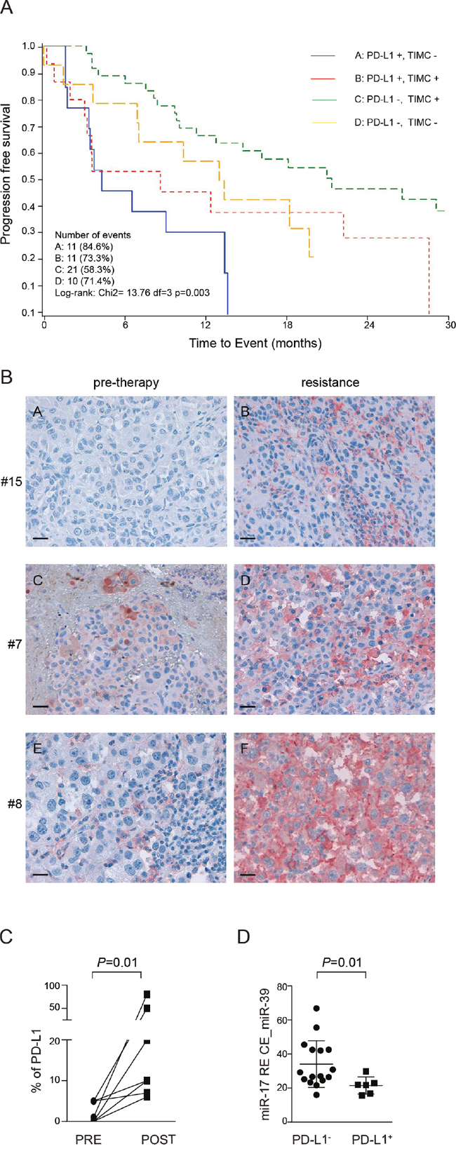 PD-L1 immunohistochemical expression in paired tissue biopsies taken before and after onset of resistance in patients treated with BRAF inhibitors (dabrafenib or vemurafenib).