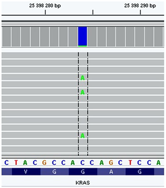 KRAS: G12V mutation detected in the EBC sample from a healthy nonsmoking subject.
