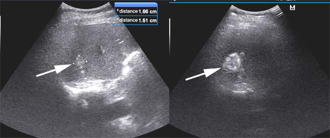 Procedure of MWA using ultrasound imaging.