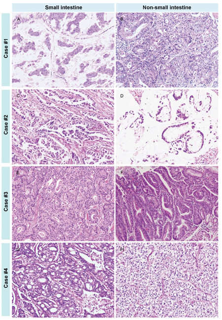 The various histologic features of SIACs and matched metachronous tumors.