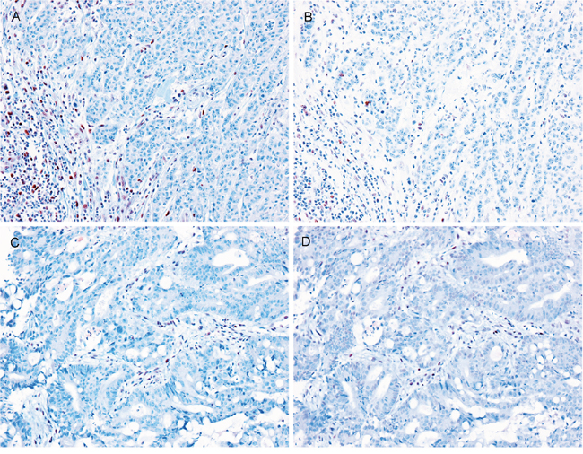 Representative images of MMR protein expression in LS-related SIACs.