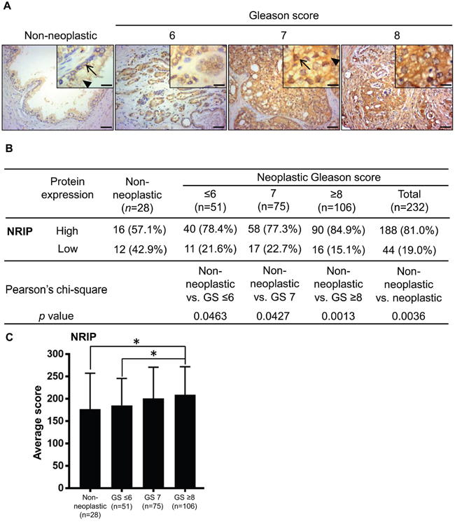 NRIP expression is increased in human prostate cancer tissues compared to non-neoplastic prostate tissues.
